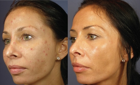 chemical peels photos