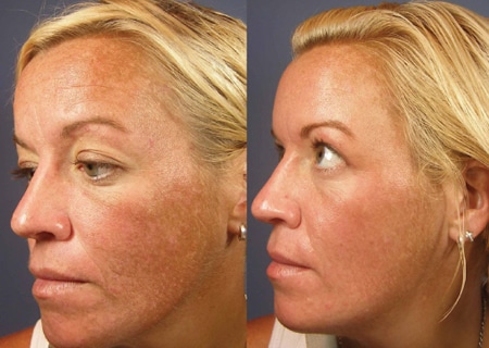 chemical peels photos