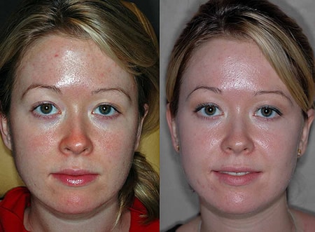 chemical peels photos