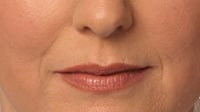 Juvederm® Washington DC | Chevy Chase MD