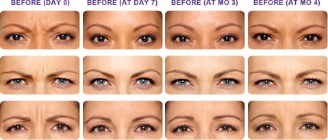 botox bethesda md