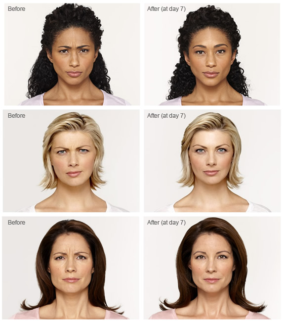 Before and after pictures of botox treatments in Chevy Chase, MD