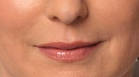 Juvederm® Washington DC | Chevy Chase MD