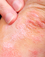 Contact Dermatitis Treatment Washington DC | Chevy Chase MD