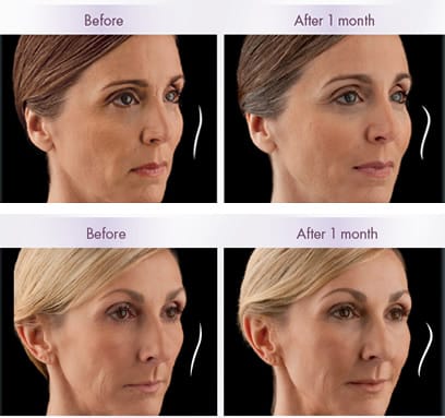 Juvéderm VOLUMA™ XC | Before & After | Washington D.C.