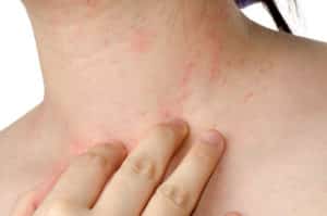 atopic dermatitis