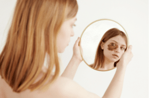 female with large brown spot on face under eye looking at mirror reflection