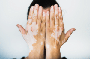 Vitiligo on the hands