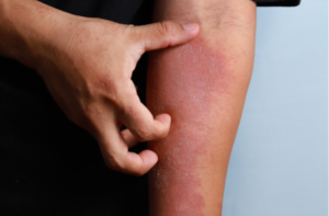 Dermatitis on skin, ill allergic rash dermatitis eczema
