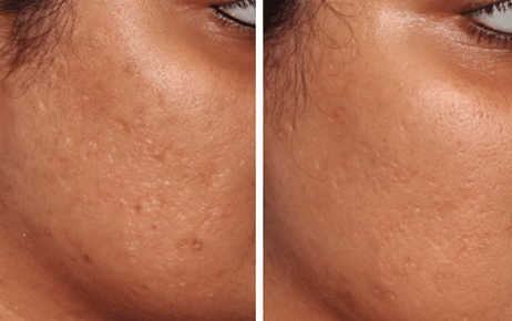 Micro Needling Before and After Photos