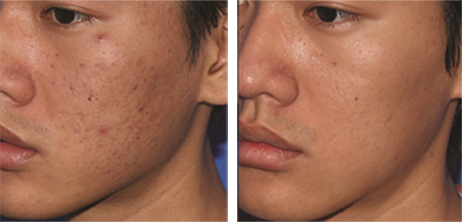 Micro Needling Before and After Photos