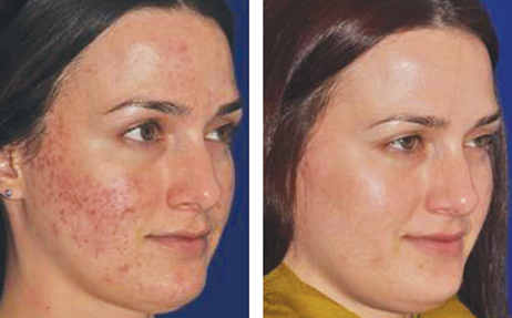 Micro Needling Before and After Photos | Chevy Chase Dermatology