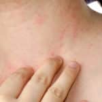 atopic dermatitis