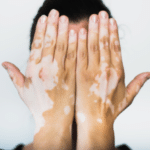 Vitiligo on the hands