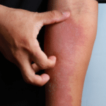 Dermatitis on skin, ill allergic rash dermatitis eczema