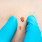 Woman with birthmark on her back, skin tags removal