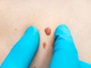Woman with birthmark on her back, skin tags removal