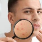 Portrait of young man with acne problem and magnifier at home