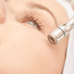 microdermabrasion