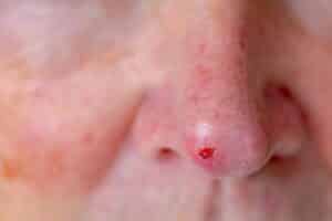 Man with red spot on nose showing signs of basal-cell carcinoma, the most common type of skin cancer