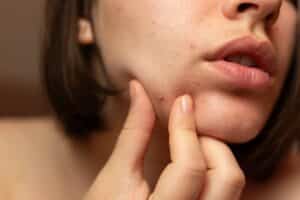 A young woman attempts to squeeze a pimple on her chin, showing visible signs of acne and highlighting common facial skincare concerns