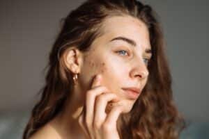 Close-up of woman’s face with acne, rash, and scars caused by cosmetic allergy, concept of skincare, dermatology, and acne treatment.