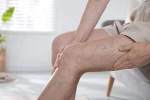 Spider veins and varicose veins on legs before treatment