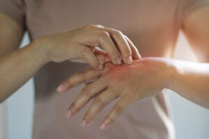 Woman scratching itchy hand from dermatitis